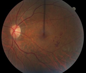 Diabetic Retinopathy 1