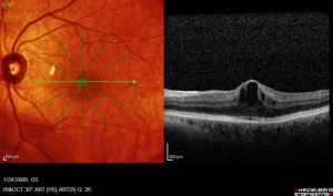 Diabetic Retinopathy 3