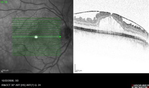 EPIRETINAL MEMBRANE