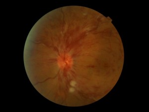 Retina vein occlusions 2