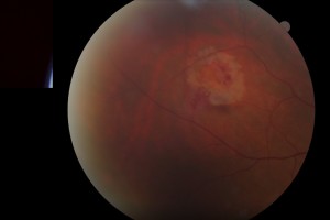 Retinal tear and detachment 1