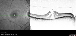 macular-hole-1