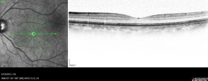 macular-hole-2